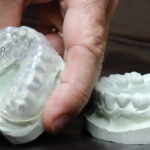 Mouthguard`s Cover Back molars. 